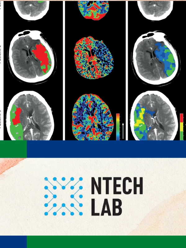 Chẩn đoán đột quỵ