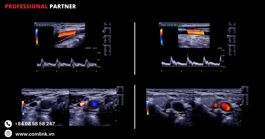 Các loại thiết bị y tế ngoại vi chụp ảnh siêu âm