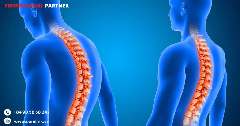 Thiếu hụt dinh dưỡng gây loãng xương