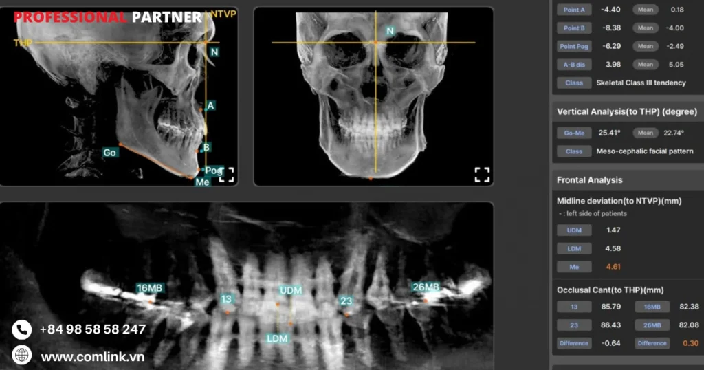 Phần mềm AICITI: Phân tích xương tự động